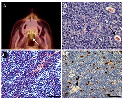 Lymphoma of the Uvula: Clinical, Morphological, Histopathological, and Genetic Characterization. A Nationwide Danish Study From 1980 to 2019